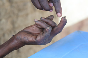 An NCA staff member examines Halima's hand. If leprosy symptoms are diagnosed early enough, patients do not lose their fingers. Credits: Sheahen/Caritas